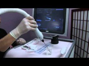 IceSense3 лечение рака молочной железы в Израиле