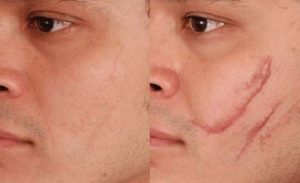 Удаление шрамов